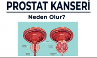 PROSTAT KANSERİNİN  OLUŞMASINDA ETKİLİ FAKTÖRLER